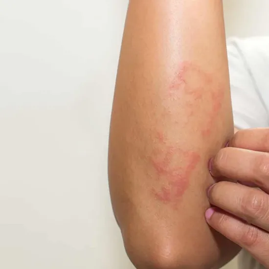 allergy panel pulses